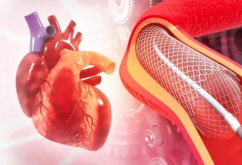 FAQs About Angioplasty Recovery in Patna
